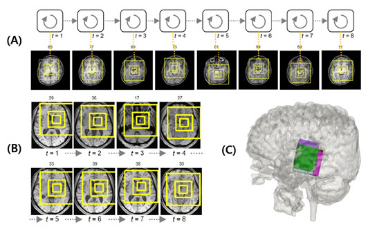 A. 세브란스병원 ASD 환자의 MRI 빅데이터에서 인공지능 모델이 자폐 중증도와 관련된 뇌 주요 부위들의 연관 관계를 찾아내는 모습 B. 국제컨소시엄으로 구축된 1000여 건의 자폐증 환자 MRI 빅데이터에서 인공지능 모델이 자폐 중증도와 관련된 뇌 주요 부위들의 연관 관계를 찾아내는 모습 C. A와 B의 주요 부위를 3차원으로 표현한 뇌 이미지.